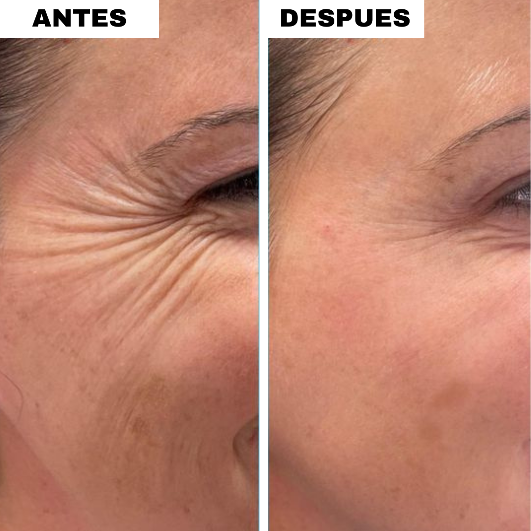 Mascarilla de colágeno Anti-Ojeras 10 Parches + 10 Parches de Regalo + Espray