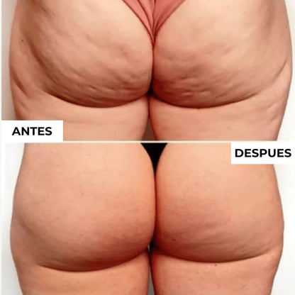 Gua Sha Anti-Celulitis (3x1).